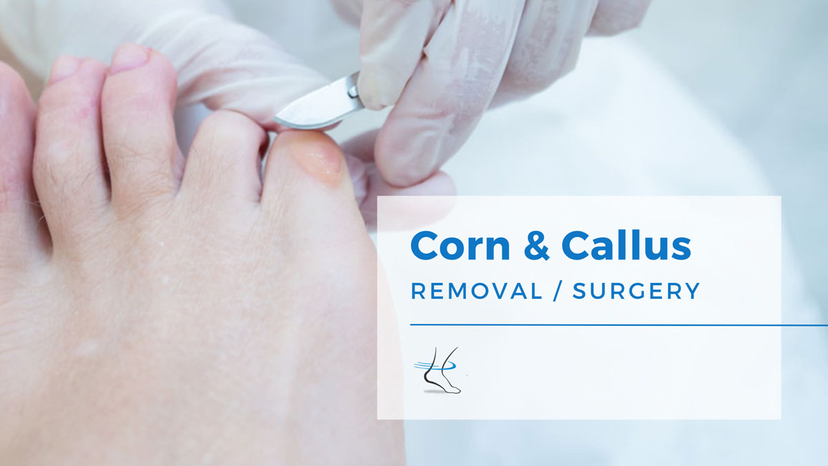 Podiatrist Callus Removal [Podiatrist Treatment for Calluses & Corns]