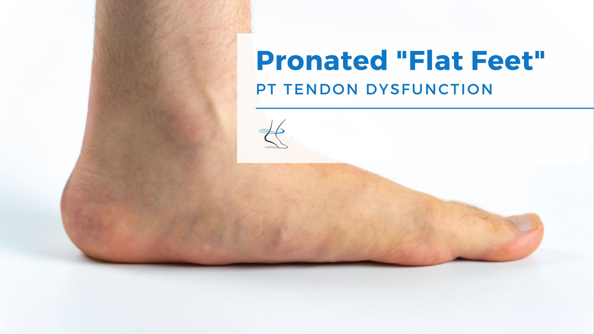 Pronated Feet - Pain? Inward Bent Boot at the Ankle?
