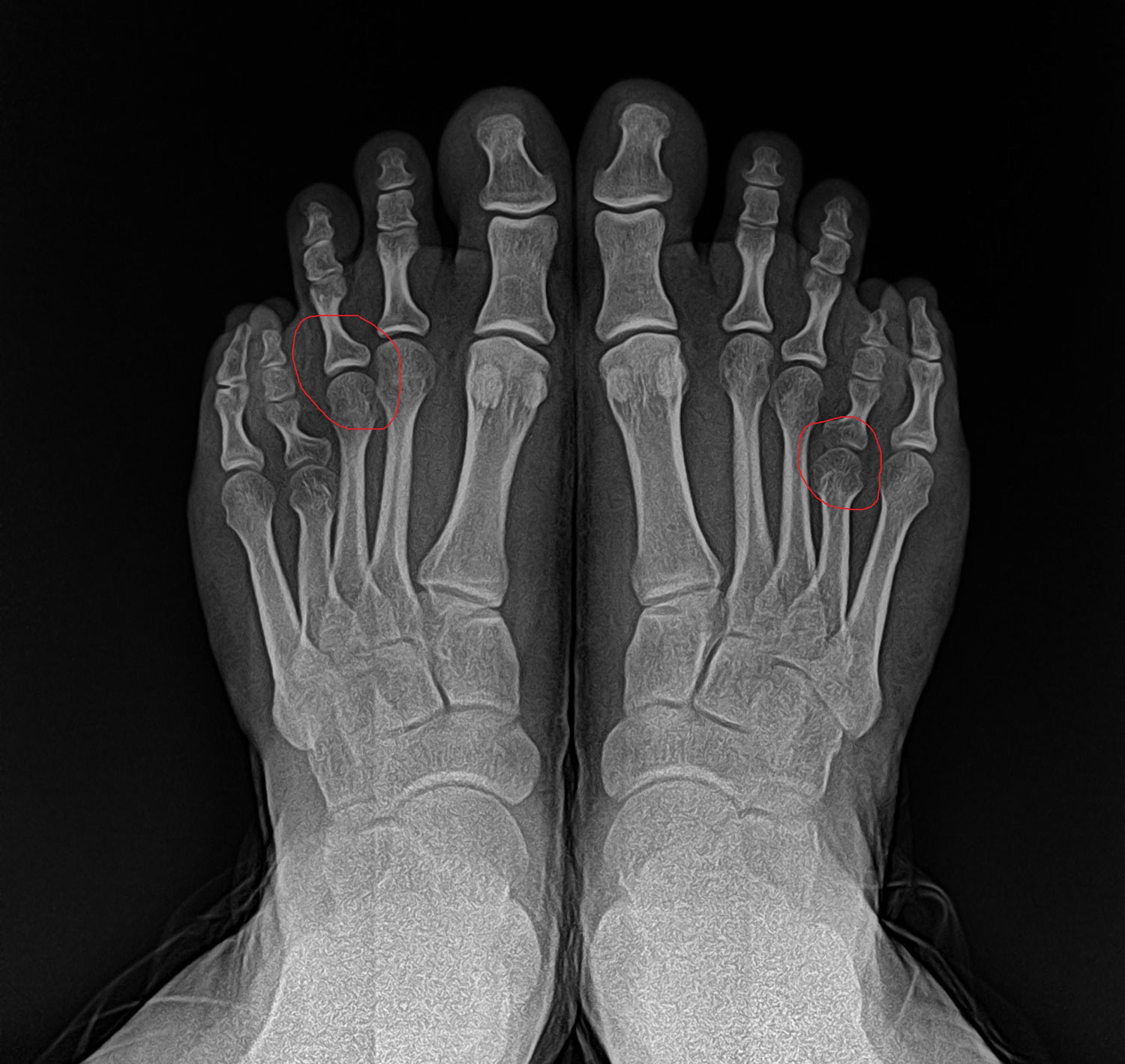 What is Brachymetatarsia?: Podiatry Hotline Foot & Ankle: Foot and