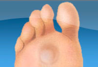 Foot Callus