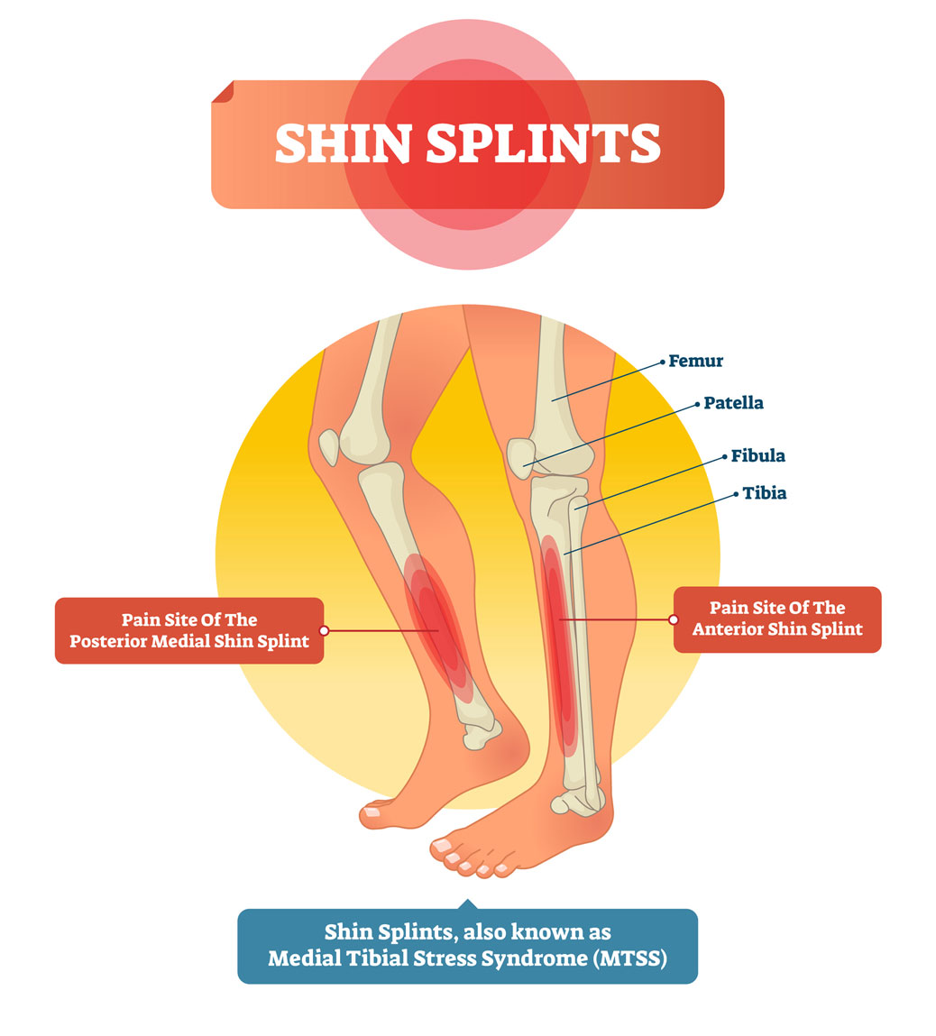 Shin Splints Treatment - Moore Foot & Ankle | Spring, TX