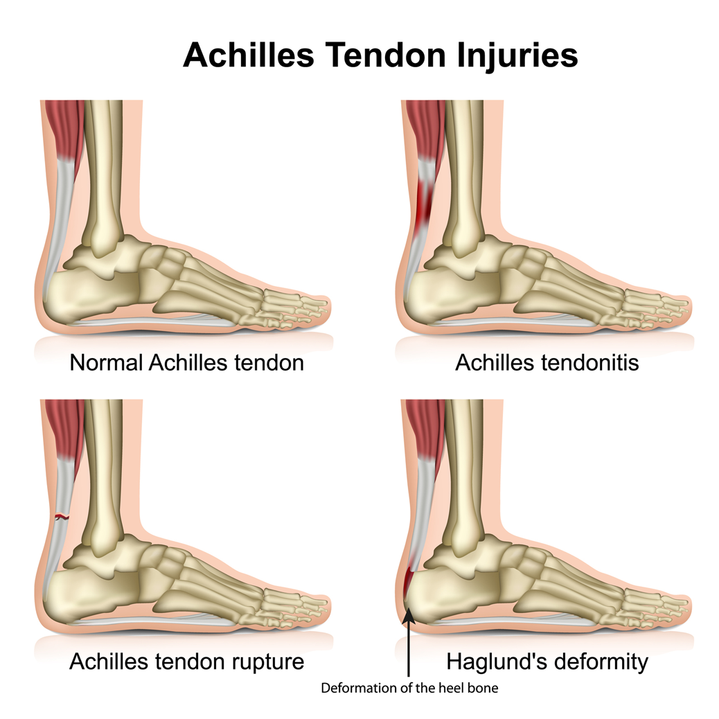 Achilles tendon injuries illustration