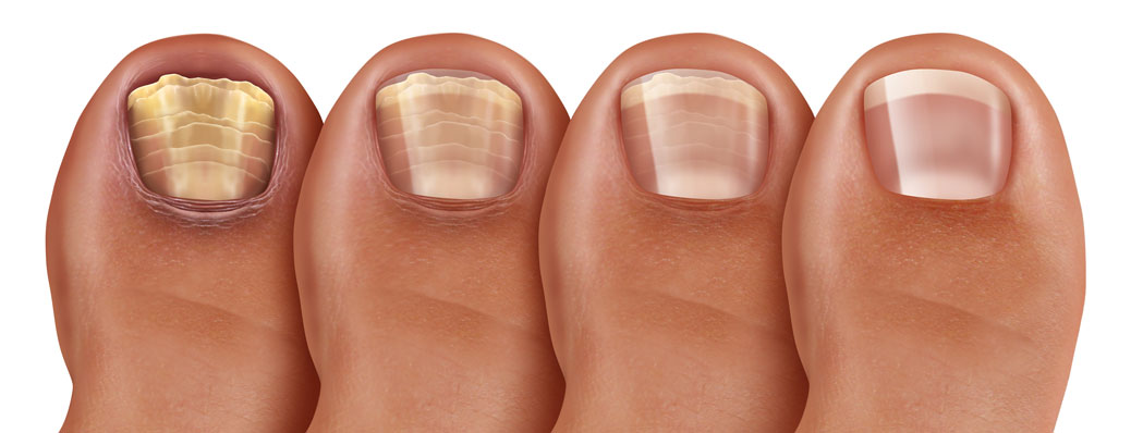 skandaløse sikring Afgang Thick Discolored Toenails: Medical Solution - Moore Foot & Ankle