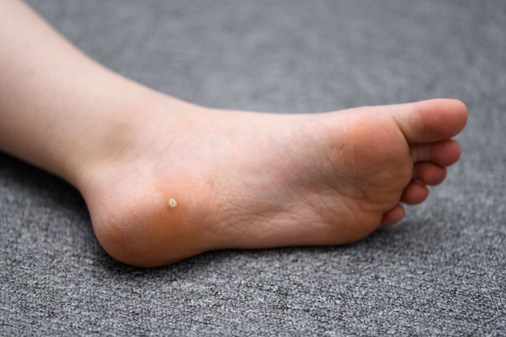 foot with warts, surgical treatment for plantar warts