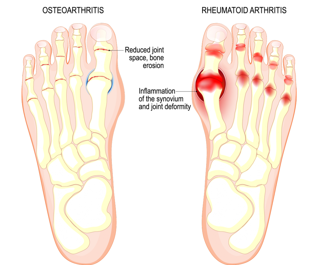 Treatment For Big Toe Joint Pain Foot Arthritis