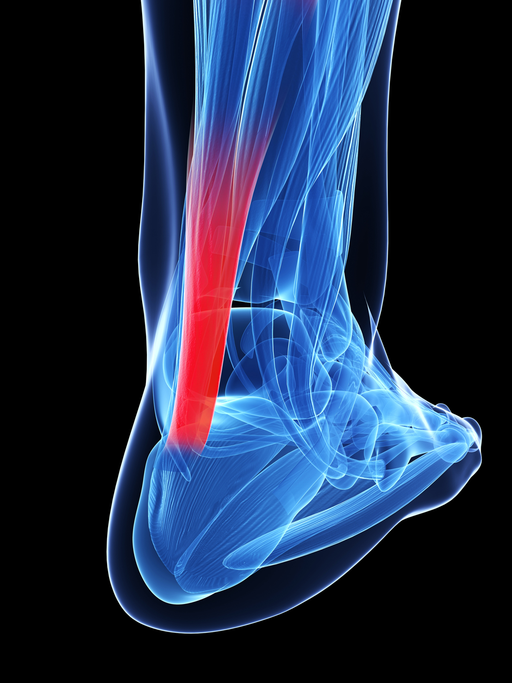 X-RAY of a feet with Achilles injury, or Achilles tendonitis