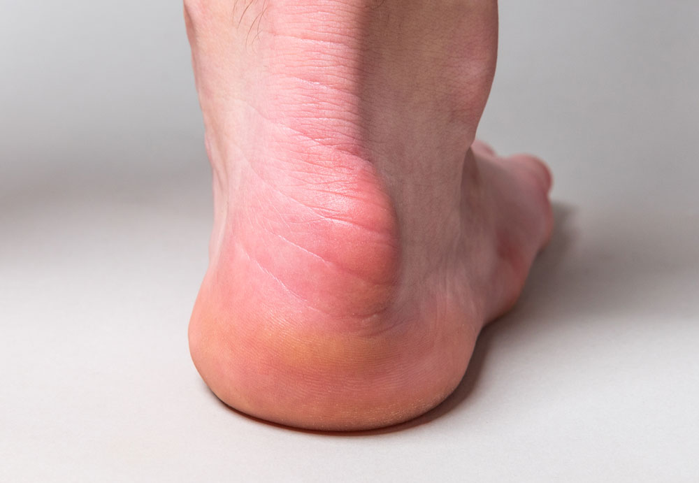 Haglunds Deformity Bump And Back Of Heel Pain